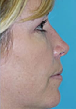 Rhinoplasty (Nose Job) Before and After Photos