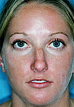 Rhinoplasty (Nose Job) Before and After Photos