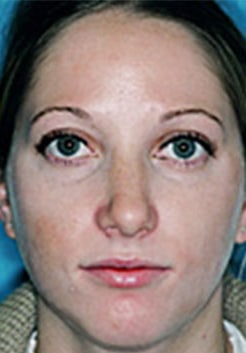 Rhinoplasty (Nose Job) Before and After Photos