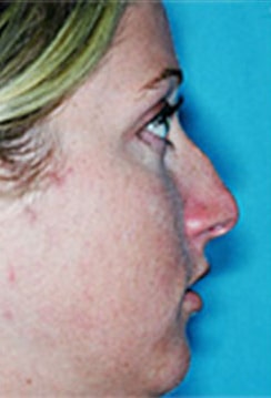 Rhinoplasty (Nose Job) Before and After Photos