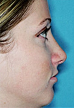 Rhinoplasty (Nose Job) Before and After Photos