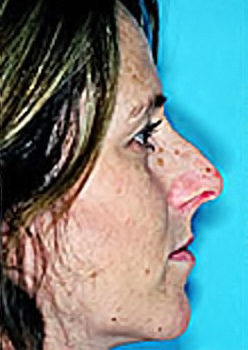 Rhinoplasty (Nose Job) Before and After Photos Case 4117 Before Photo Rhinoplasty (Nose Job) Before and After Photos