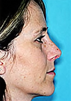 Rhinoplasty (Nose Job) Before and After Photos Case 4117 After Photo Rhinoplasty (Nose Job) Before and After Photos