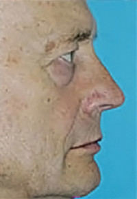 Rhinoplasty (Nose Job)