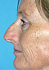 Rhinoplasty (Nose Job)