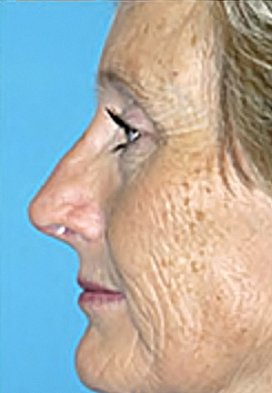 Rhinoplasty (Nose Job) Before and After Photos Case 4129 After Photo Rhinoplasty (Nose Job) Before and After Photos
