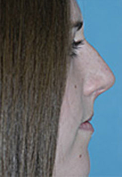 Rhinoplasty (Nose Job) Before and After Photos Case 4135 Before Photo Rhinoplasty (Nose Job) Before and After Photos