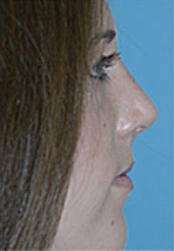 Rhinoplasty (Nose Job) Before and After Photos Case 4135 After Photo Rhinoplasty (Nose Job) Before and After Photos