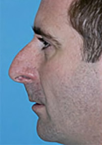 Rhinoplasty (Nose Job)