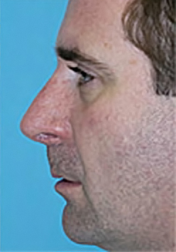 Rhinoplasty (Nose Job) Before and After Photos Case 4141 After Photo Rhinoplasty (Nose Job) Before and After Photos