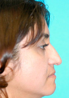 Rhinoplasty (Nose Job) Before and After Photos Case 4147 Before Photo Rhinoplasty (Nose Job) Before and After Photos
