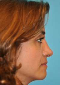 Rhinoplasty (Nose Job)