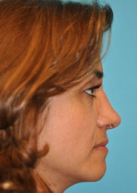 Rhinoplasty (Nose Job) Before and After Photos