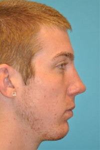 Rhinoplasty (Nose Job) Before and After Photos