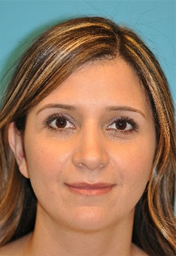 Rhinoplasty (Nose Job) Before and After Photos Case 4171 After Photo Rhinoplasty (Nose Job) Before and After Photos