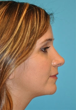 Rhinoplasty (Nose Job) Before and After Photos Case 4171 After Photo Rhinoplasty (Nose Job) Before and After Photos