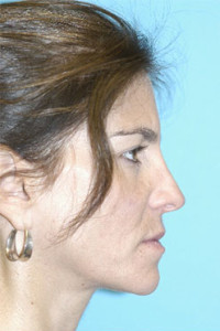 Rhinoplasty (Nose Job) Before and After Photos