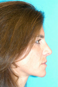 Rhinoplasty (Nose Job) Before and After Photos