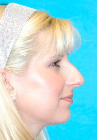 Rhinoplasty (Nose Job) Before and After Photos