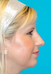 Rhinoplasty (Nose Job) Before and After Photos