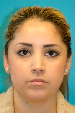 Rhinoplasty (Nose Job) Before and After Photos Case 4189 After Photo Rhinoplasty (Nose Job) Before and After Photos