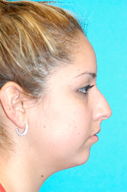 Rhinoplasty (Nose Job) Before and After Photos Case 4189 Before Photo Rhinoplasty (Nose Job) Before and After Photos