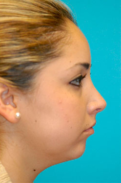 Rhinoplasty (Nose Job) Before and After Photos Case 4189 After Photo Rhinoplasty (Nose Job) Before and After Photos