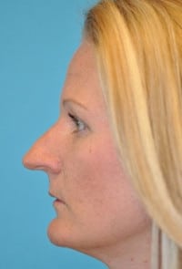Rhinoplasty (Nose Job) Before and After Photos