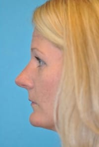 Rhinoplasty (Nose Job) Before and After Photos