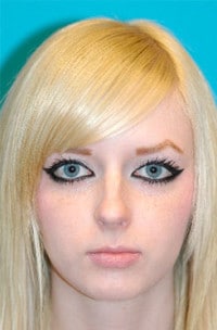 Rhinoplasty (Nose Job) Before and After Photos