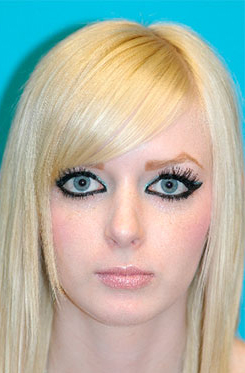 Rhinoplasty (Nose Job) Case 4201 After Photo Rhinoplasty (Nose Job)