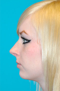 Rhinoplasty (Nose Job) Before and After Photos