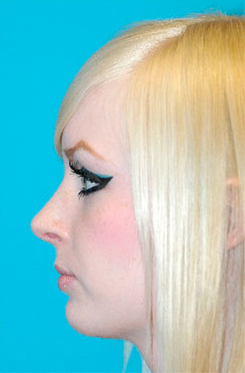 Rhinoplasty (Nose Job) Case 4201 After Photo Rhinoplasty (Nose Job)