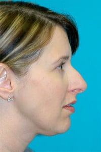 Rhinoplasty (Nose Job) Before and After Photos