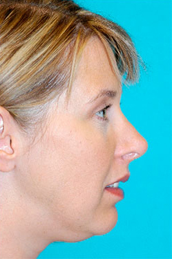 Rhinoplasty (Nose Job) Before and After Photos