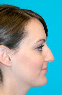 Rhinoplasty (Nose Job) Before and After Photos