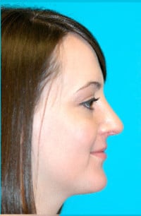 Rhinoplasty (Nose Job) Before and After Photos