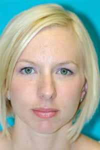 Rhinoplasty (Nose Job) Before and After Photos