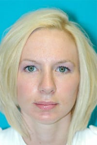 Rhinoplasty (Nose Job) Before and After Photos