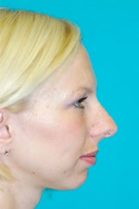 Rhinoplasty (Nose Job) Before and After Photos