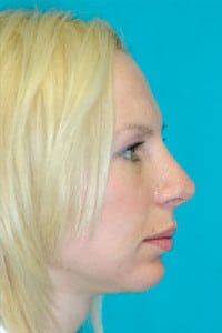 Rhinoplasty (Nose Job) Before and After Photos