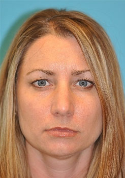 Rhinoplasty (Nose Job) Before and After Photos Case 4225 Before Photo Rhinoplasty (Nose Job) Before and After Photos