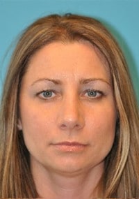 Rhinoplasty (Nose Job) Before and After Photos