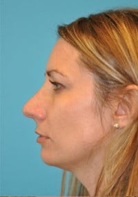Rhinoplasty (Nose Job) Before and After Photos