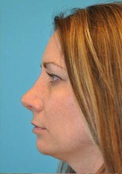 Rhinoplasty (Nose Job) Before and After Photos Case 4225 After Photo Rhinoplasty (Nose Job) Before and After Photos