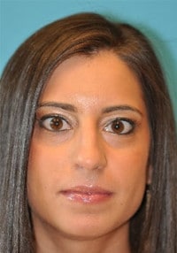 Rhinoplasty (Nose Job) Before and After Photos
