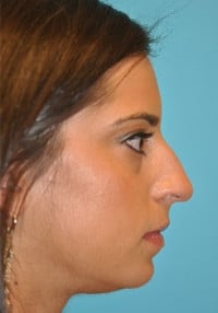 Rhinoplasty (Nose Job) Before and After Photos