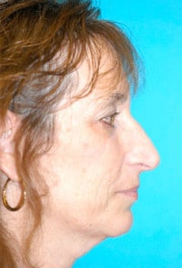 Rhinoplasty (Nose Job) Before and After Photos