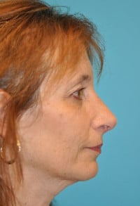 Rhinoplasty (Nose Job) Before and After Photos