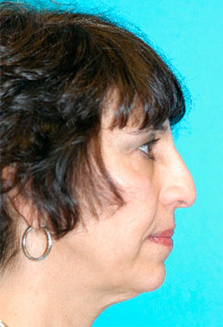 Rhinoplasty (Nose Job) Before and After Photos Case 4243 Before Photo Rhinoplasty (Nose Job) Before and After Photos